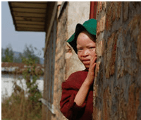 EdmondAlbinosAfrique Edmond